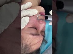 Cilt Pigmentasyonu Lezyonları Problem Tedavisi İçin 1064nm 532nm Salon Pikosaniye Lazer Makinesi